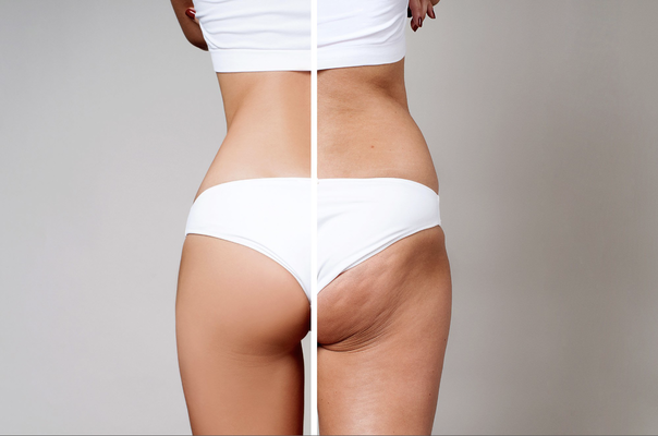 WIE KANN MAN CELLULITE LOSWERDEN?