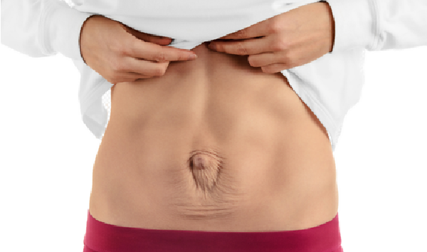 EVERYTHING YOU NEED TO KNOW ABOUT DIASTASIS RECTI